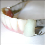 soldadura por láser junto a acrílico, reparaciones en laboratorios dentales
